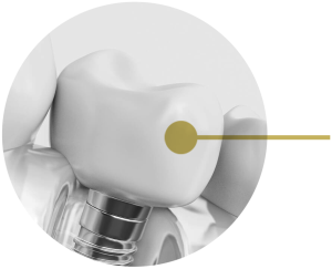 Tips For Choosing The Right Dentist For Implants