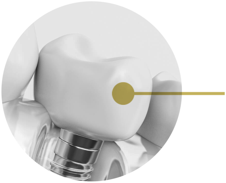 Tips For Choosing The Right Dentist For Implants